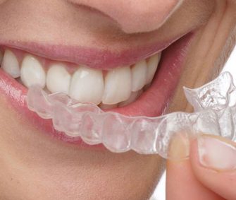 Invisalign